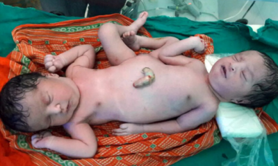 Tragic Birth Of Conjoined Twins Shocks Indian Hospital