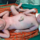 Tragic Birth Of Conjoined Twins Shocks Indian Hospital