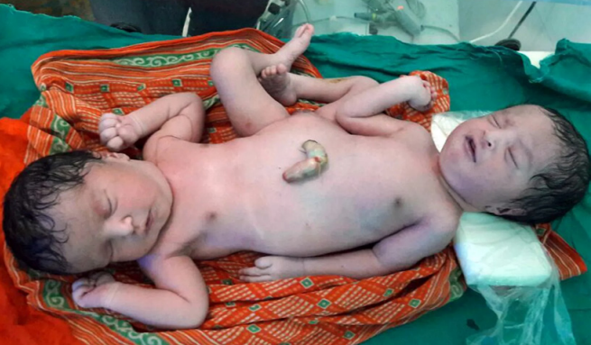 Tragic Birth Of Conjoined Twins Shocks Indian Hospital