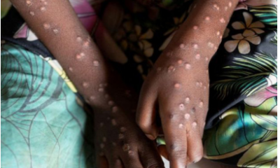 Mpox Outbreak Spreads Across Central African Republic, Declares Emergency As Infections Reach Capital City