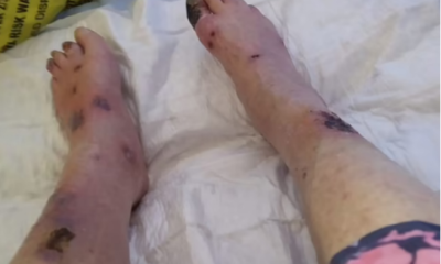 Irish Grandmother Loses Both Legs After Mosquito Bite Turned Deadly