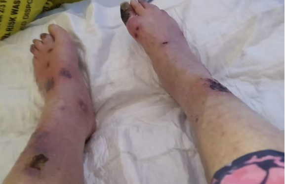 Irish Grandmother Loses Both Legs After Mosquito Bite Turned Deadly